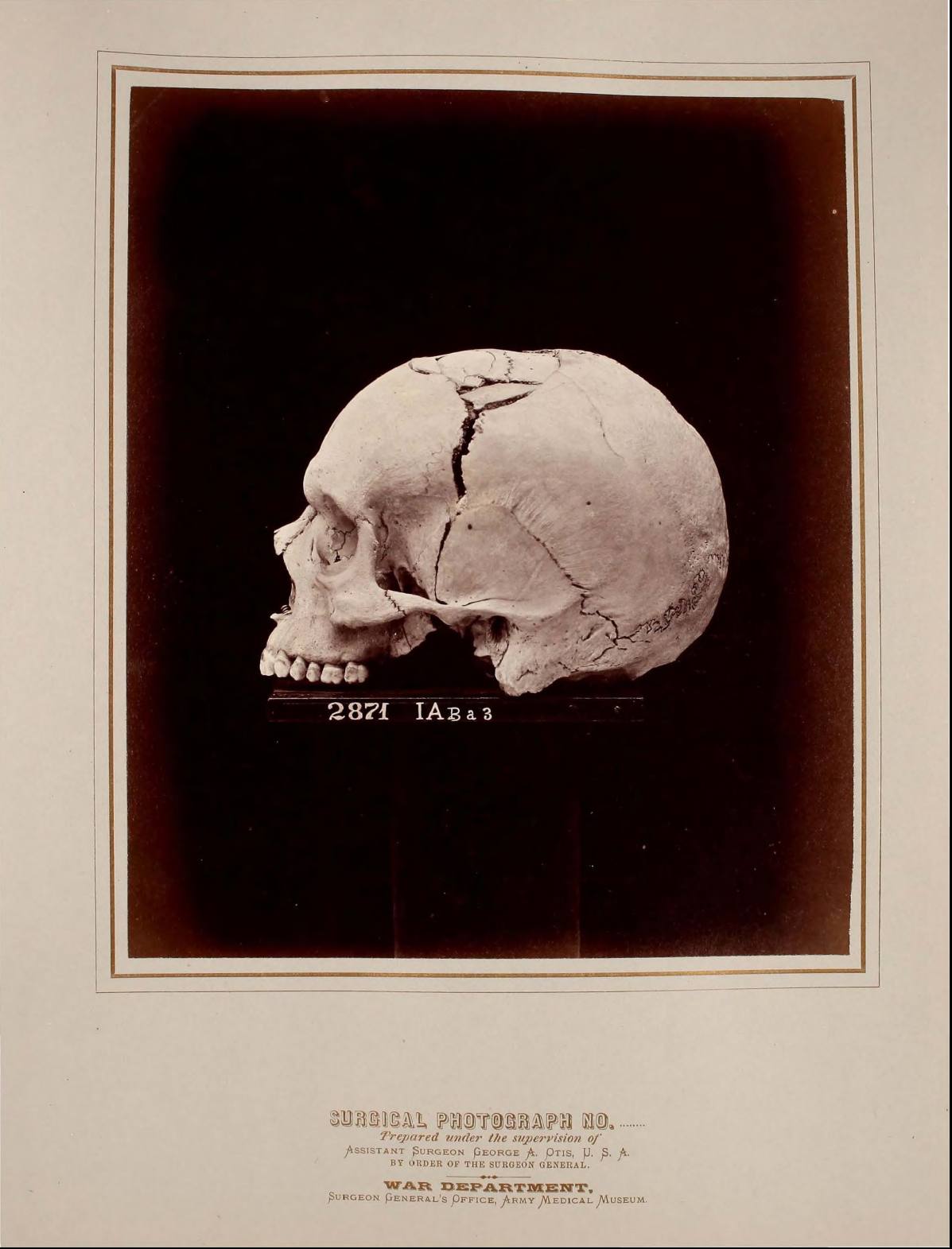 Civil War U.S. Surgeon General Photographs of Surgical Cases and Specimens Sample page 3